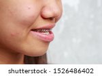 Small photo of Teen Asian Ethnicity Problems with teeth can be treated with braces to treat symptoms prognathism make mouth awry.