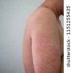 Small photo of Rubella, also know as German measles or three-day measles, is na infection cause by the rebella virus.